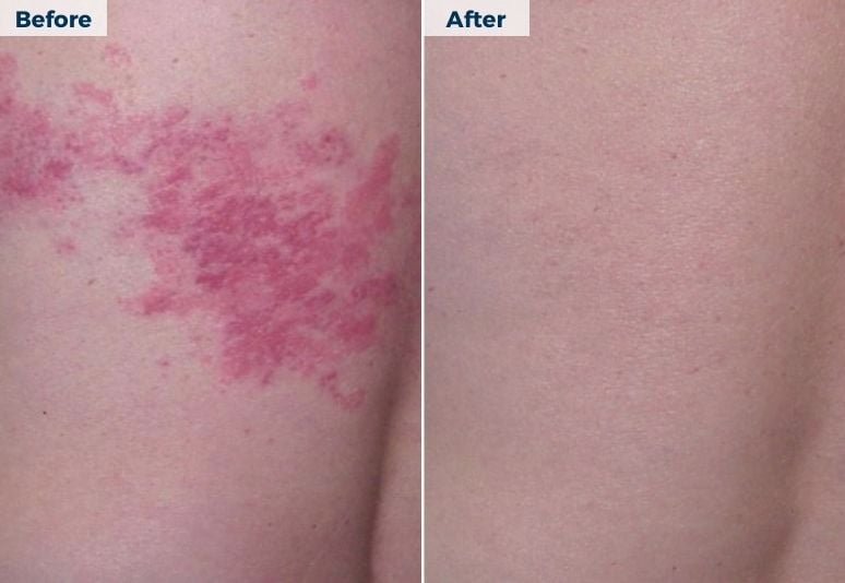 How to treat psoriasis, dermatitis and eczema